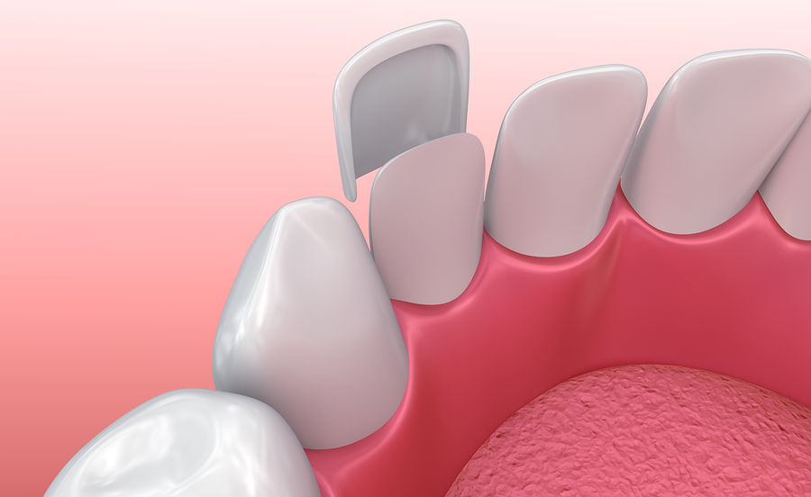 Veneers in der Türkei