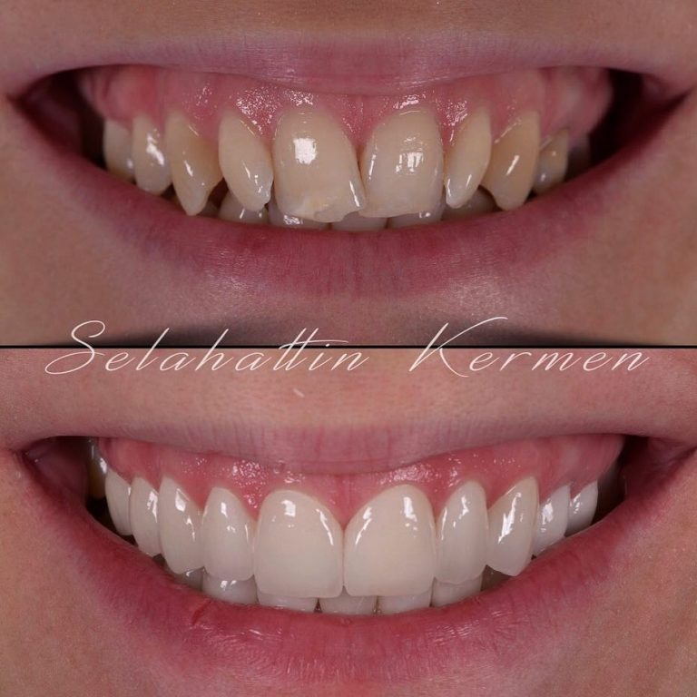 Laminate Veneers in Istanbul Veneers in der Türkei