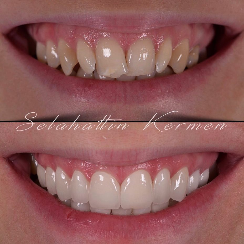 Veneers Türkei