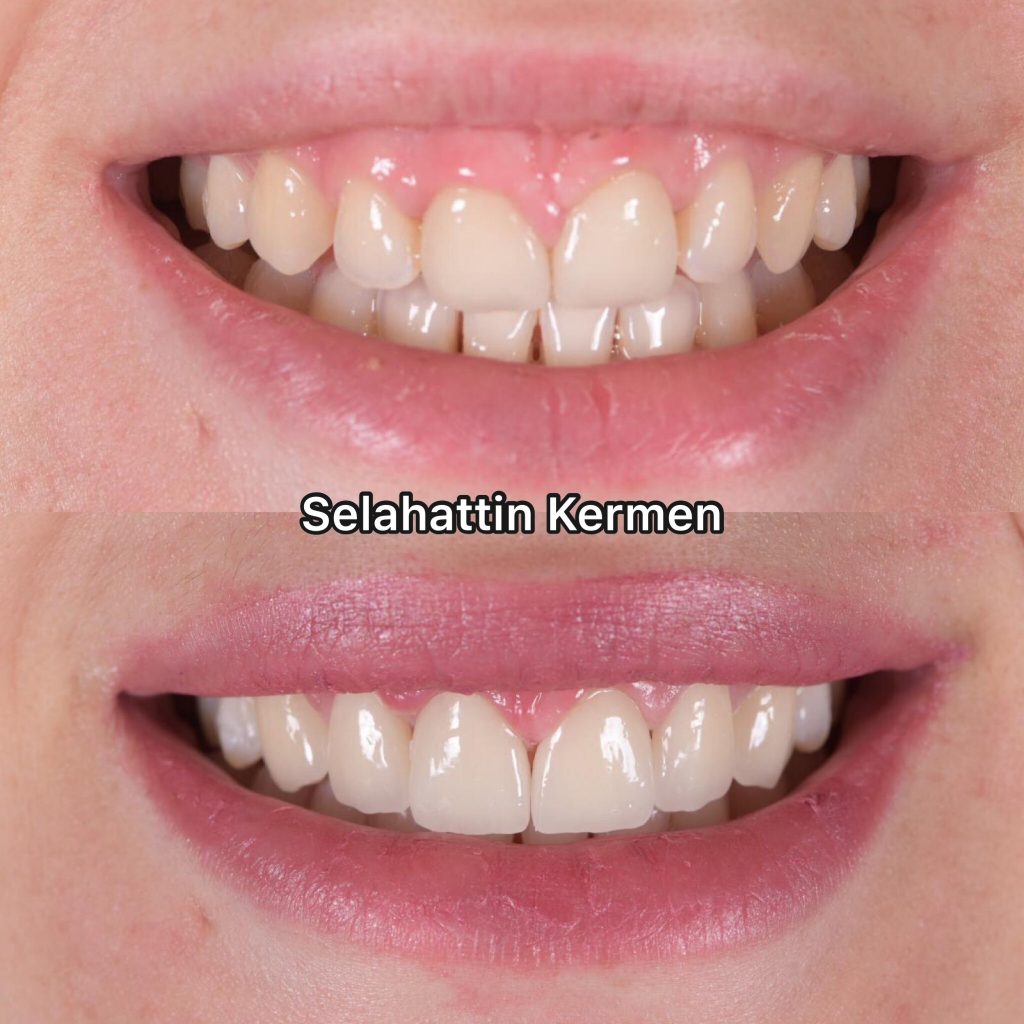 Laminate Veneers in Istanbul Veneers in der Türkei