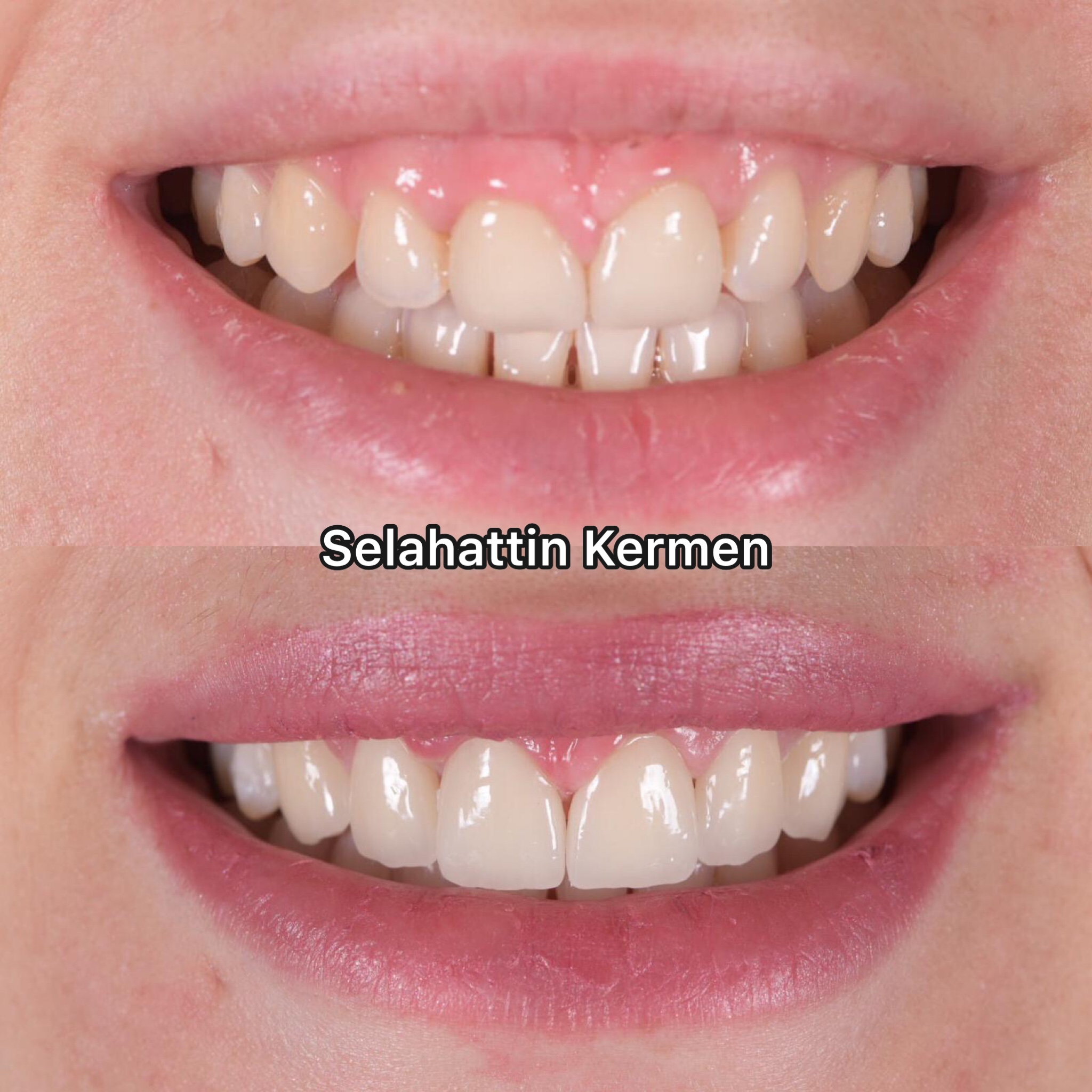 Veneers Türkei