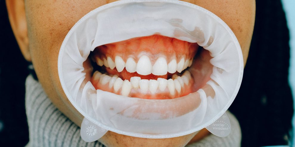 Gummysmile Gummysmile