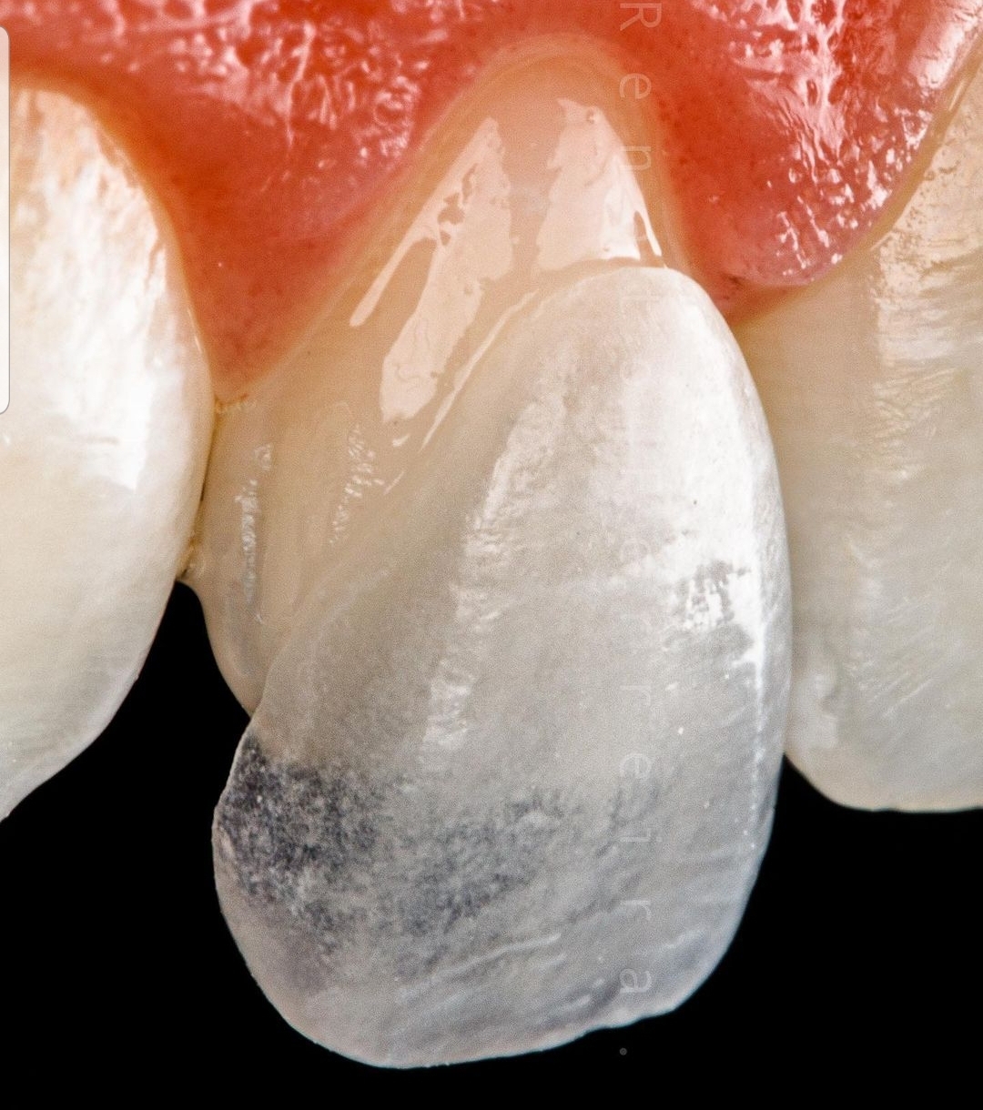 So wird ein Veneer geklebt