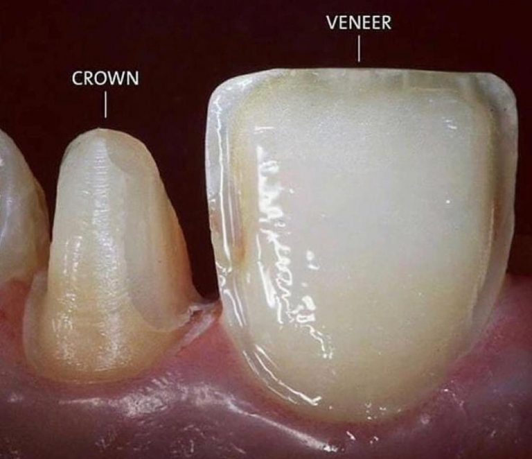 Laminate Veneers in Istanbul Veneers in der Türkei