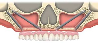 Zygoma Implantate ZYGOMA IMPLANTAT