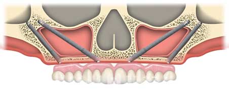 ZYGOMA IMPLANTAT