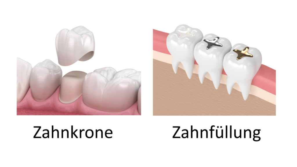 Zahnfüllung oder Zahnkrone