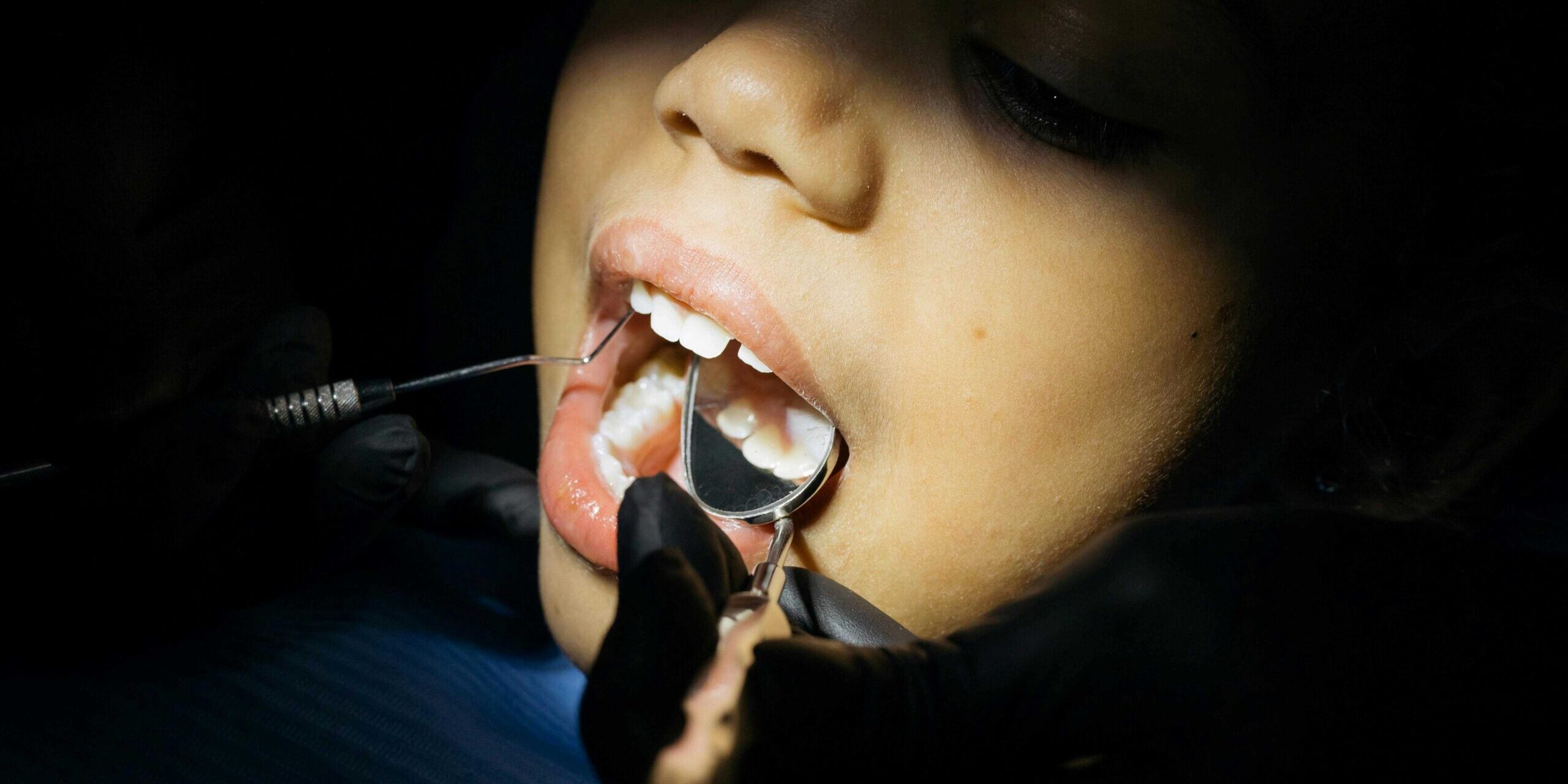 Tipps nach der Weisheitszahnentfernung Tipps nach der Weisheitszahnentfernung