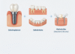 Alternativen zu Zahnimplantaten